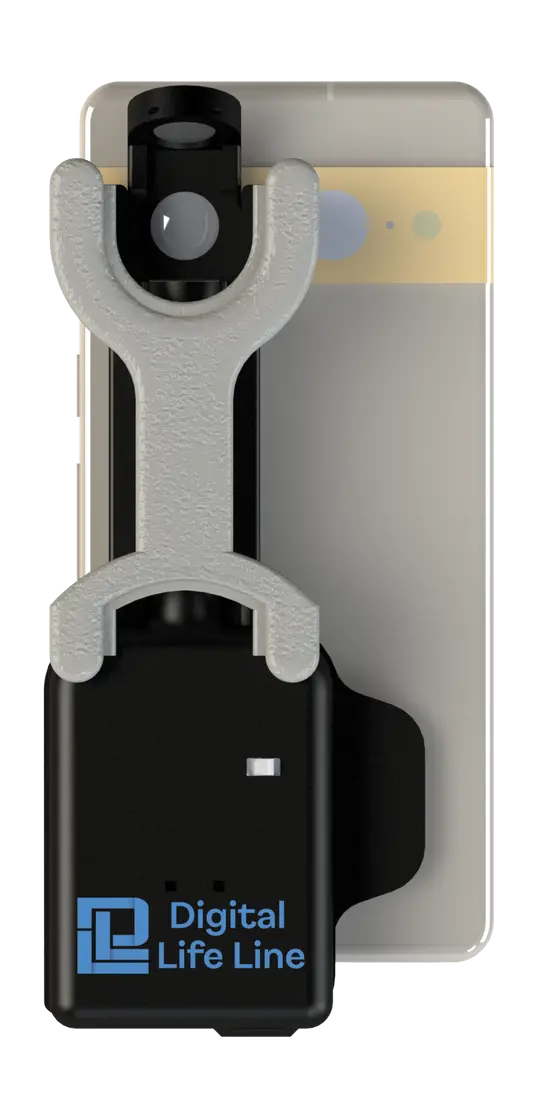 Render of the MIDAS smartphone-mounted cataract screening device
